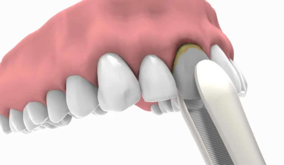 cirugia post extraccion clinica doctor charani